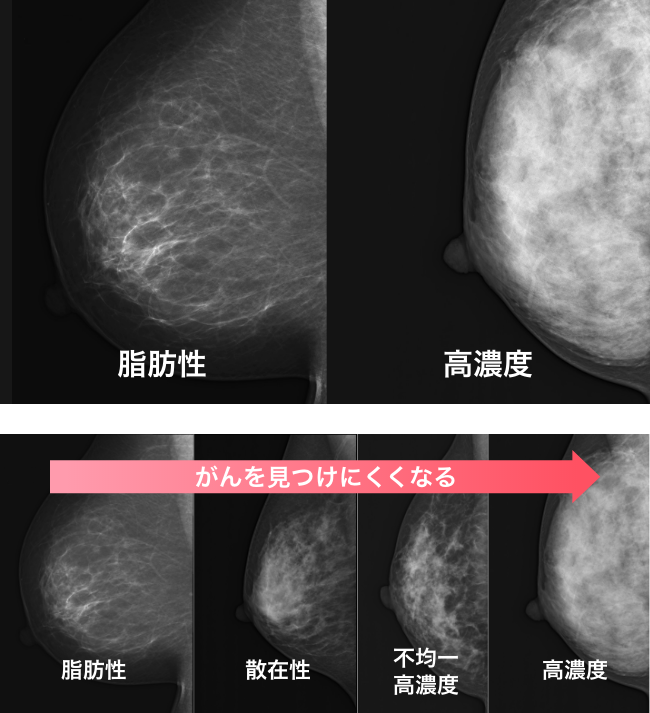 マンモグラフィ検査でのがんの見え方の違い、がんも白いので見つかりにくい(乳腺が多いと白くなる)