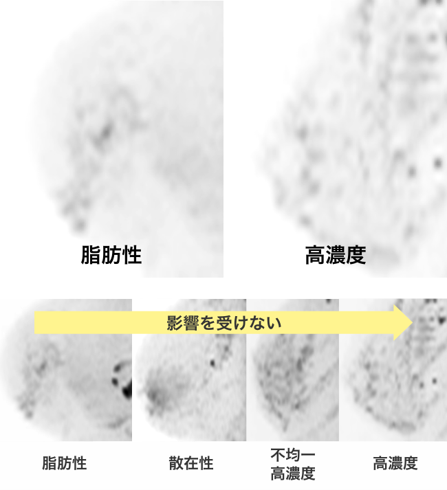 MRI検査での見え方の違い、がんは黒いので見つかりやすい(乳腺の量に影響を受けない)