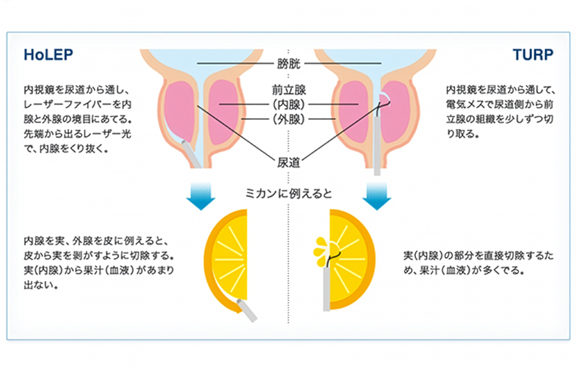 HoLEPとTURPのちがい