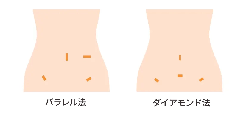 腹腔鏡下手術