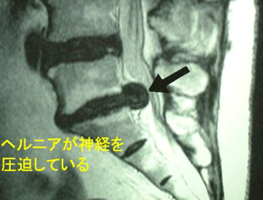 椎間板ヘルニア