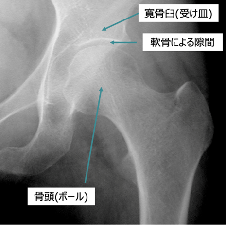 左股関節のレントゲン(正常)